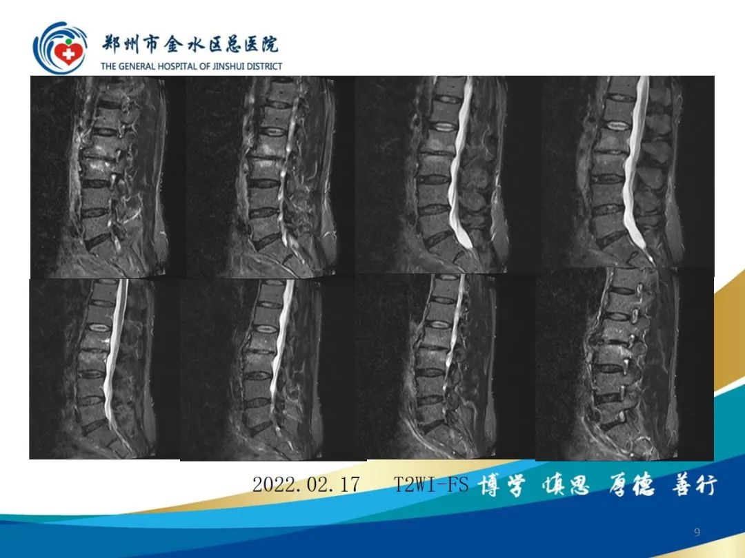 影像PPT - 【PPT】布鲁氏杆菌脊柱炎-9