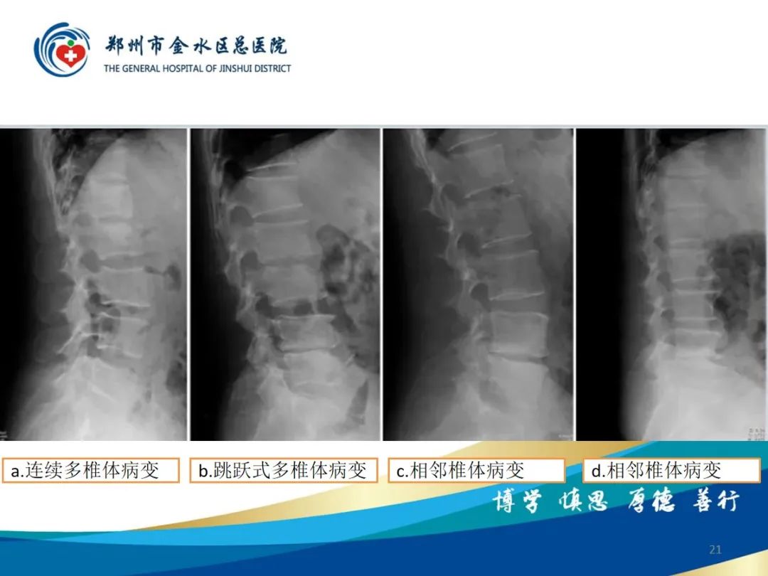 影像PPT - 【PPT】布鲁氏杆菌脊柱炎-21