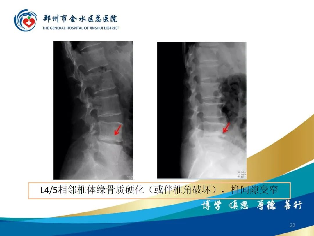 影像PPT - 【PPT】布鲁氏杆菌脊柱炎-22