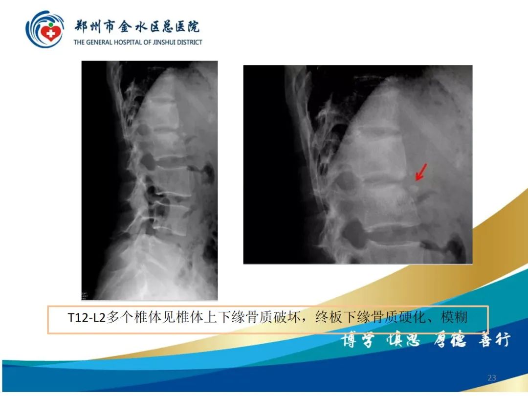 影像PPT - 【PPT】布鲁氏杆菌脊柱炎-23