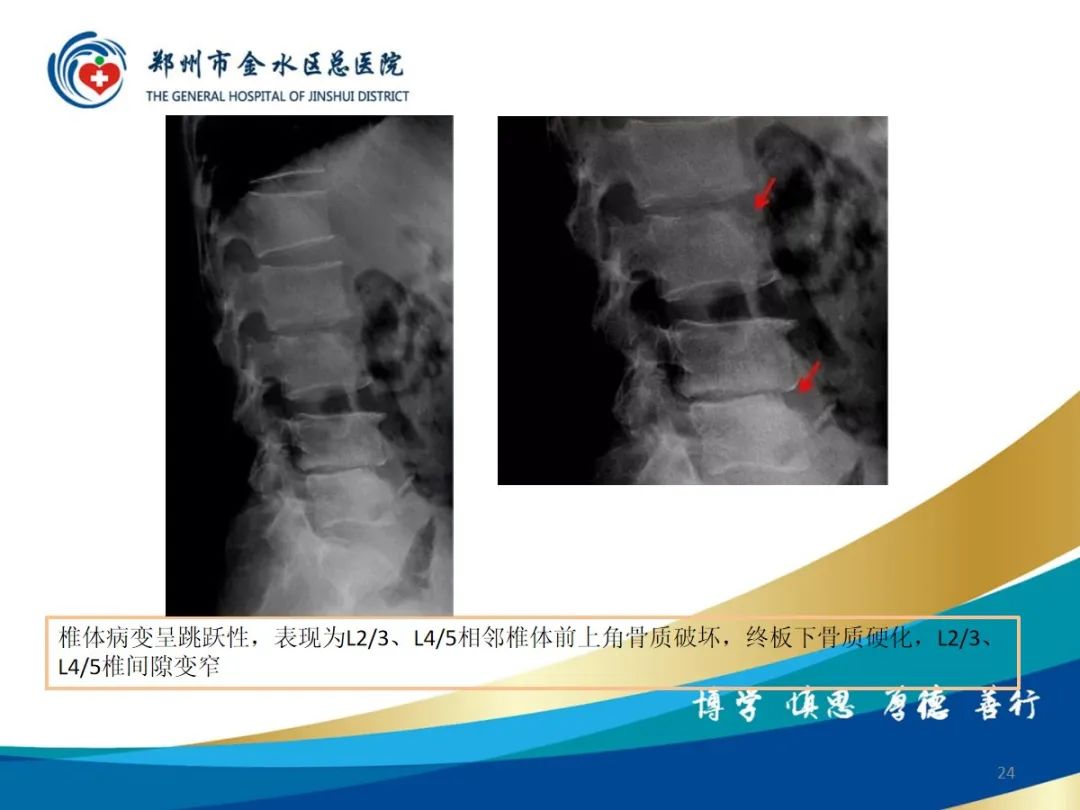 影像PPT - 【PPT】布鲁氏杆菌脊柱炎-24