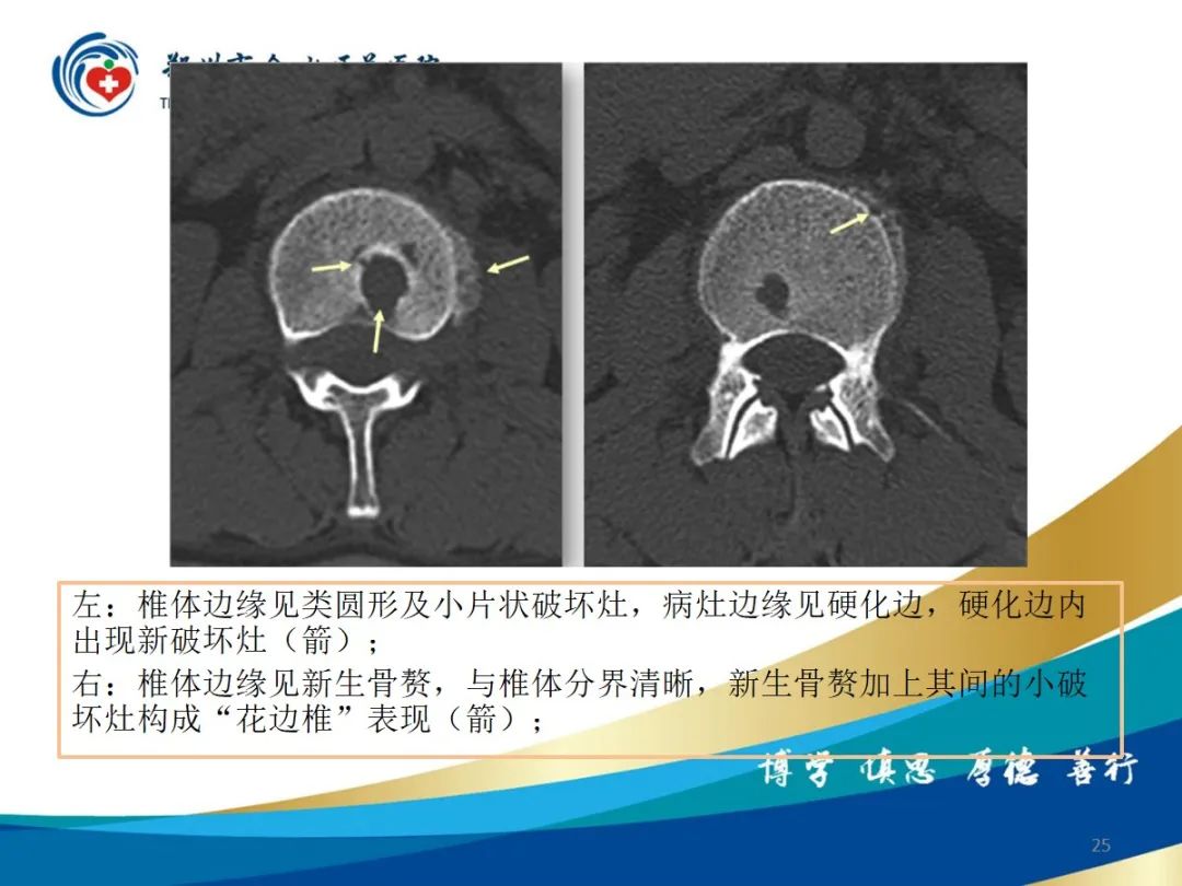 影像PPT - 【PPT】布鲁氏杆菌脊柱炎-25