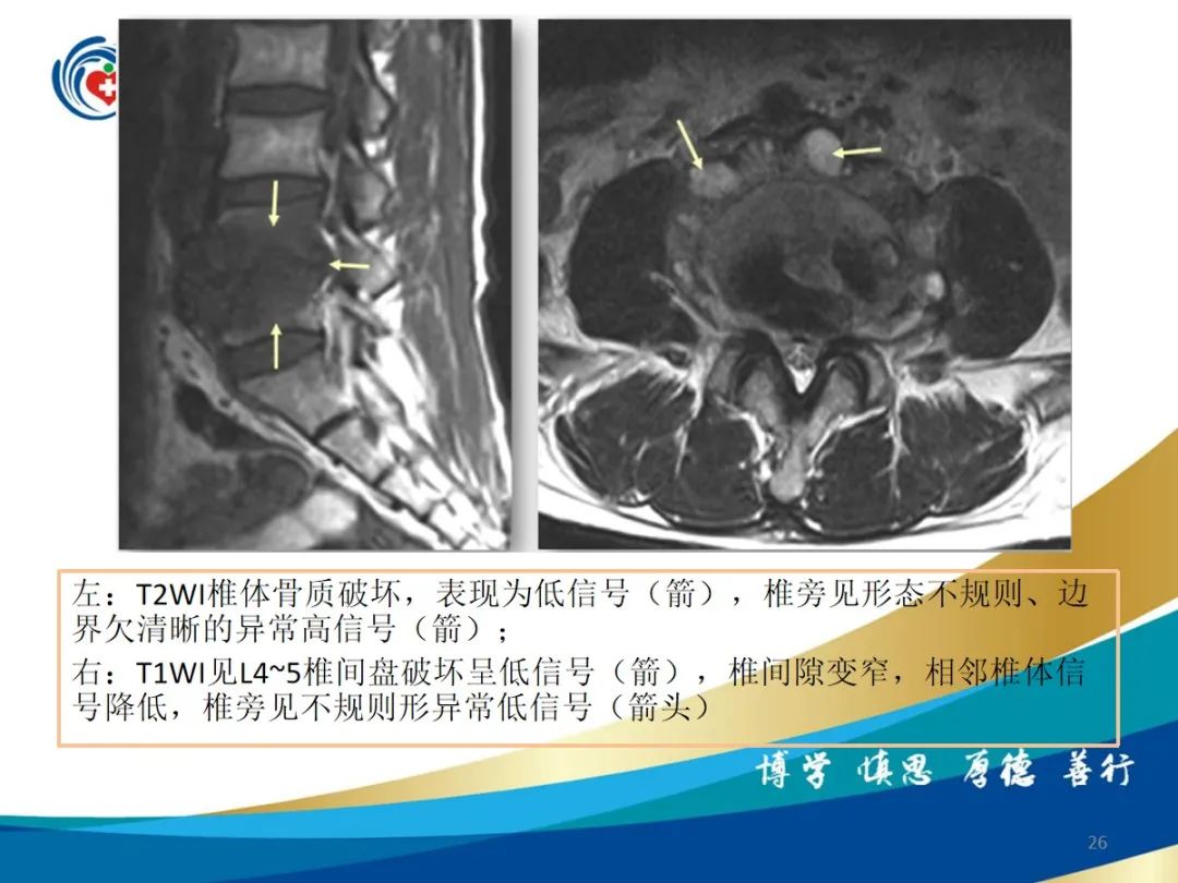 影像PPT - 【PPT】布鲁氏杆菌脊柱炎-26