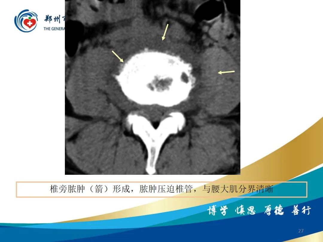 影像PPT - 【PPT】布鲁氏杆菌脊柱炎-27