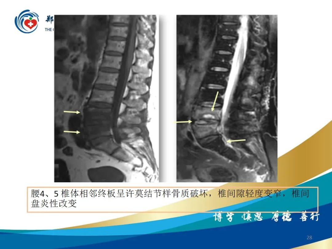 影像PPT - 【PPT】布鲁氏杆菌脊柱炎-28