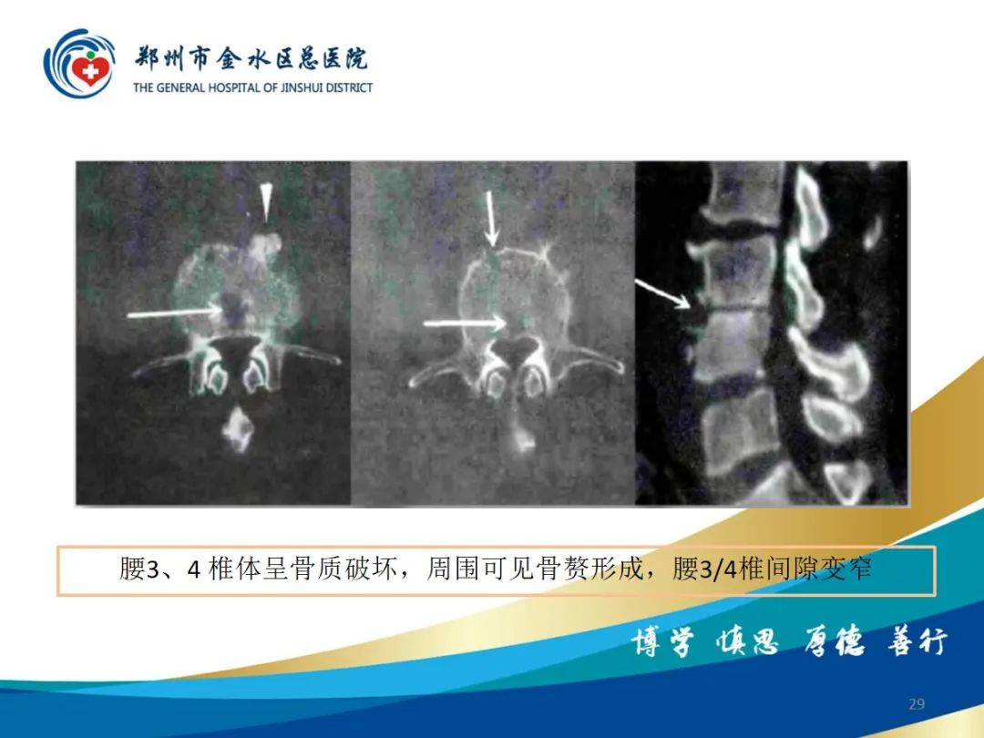 影像PPT - 【PPT】布鲁氏杆菌脊柱炎-29