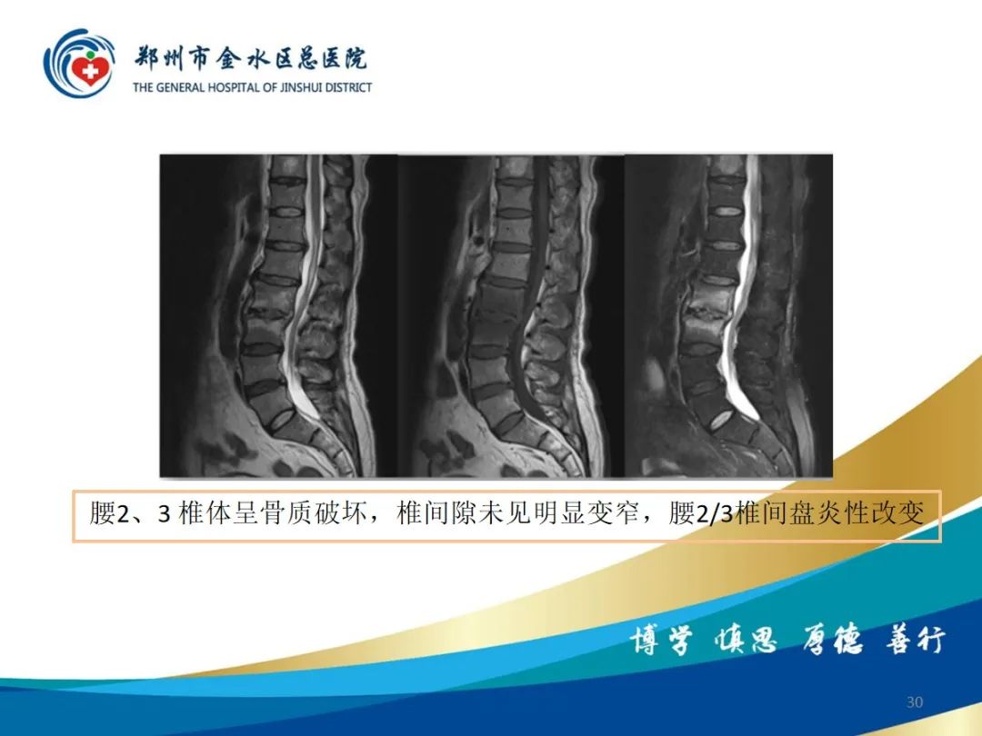 影像PPT - 【PPT】布鲁氏杆菌脊柱炎-30