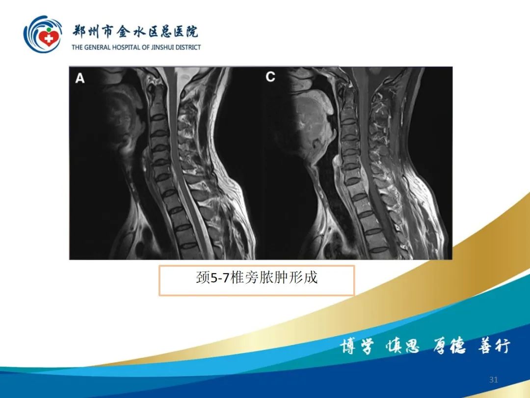 影像PPT - 【PPT】布鲁氏杆菌脊柱炎-31