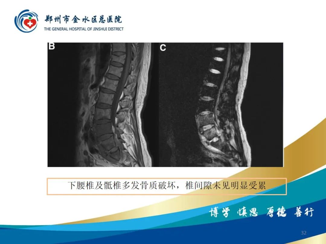 影像PPT - 【PPT】布鲁氏杆菌脊柱炎-32