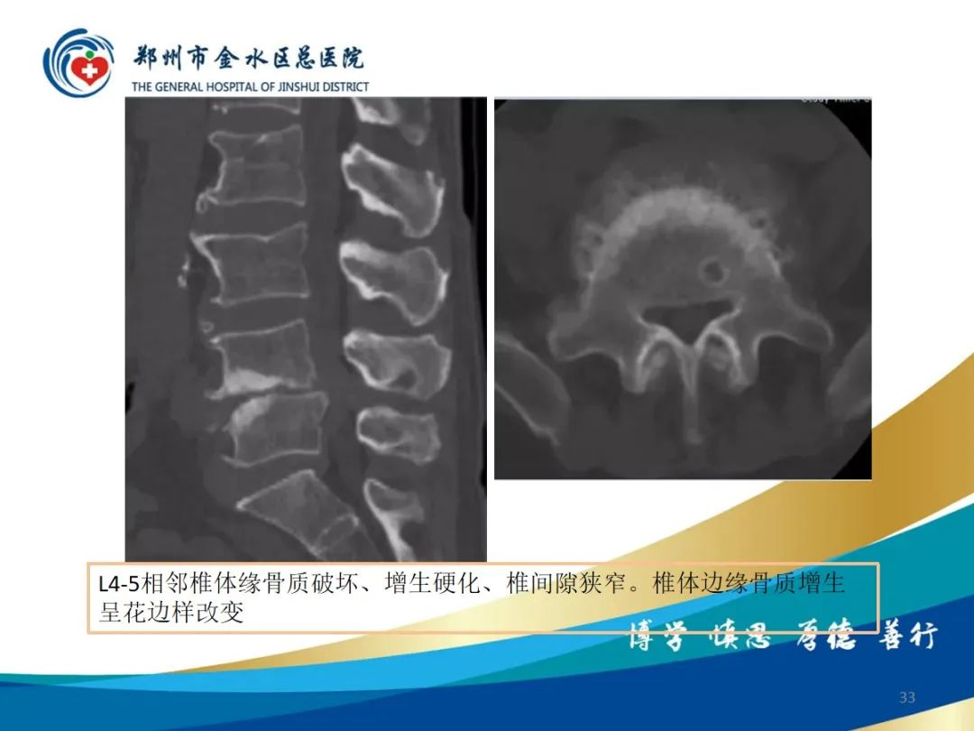 影像PPT - 【PPT】布鲁氏杆菌脊柱炎-33