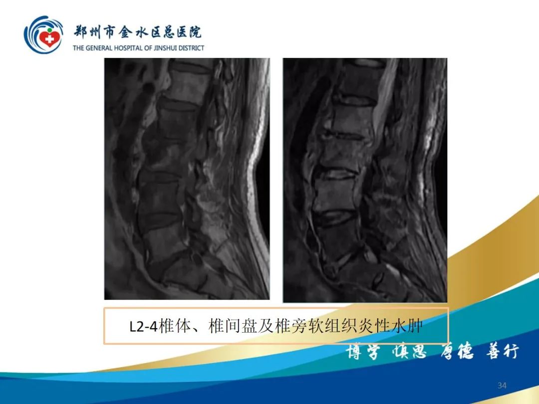 影像PPT - 【PPT】布鲁氏杆菌脊柱炎-34