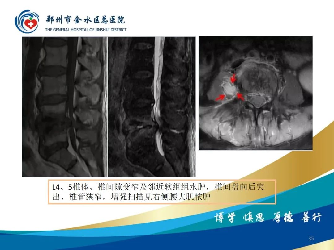 影像PPT - 【PPT】布鲁氏杆菌脊柱炎-35