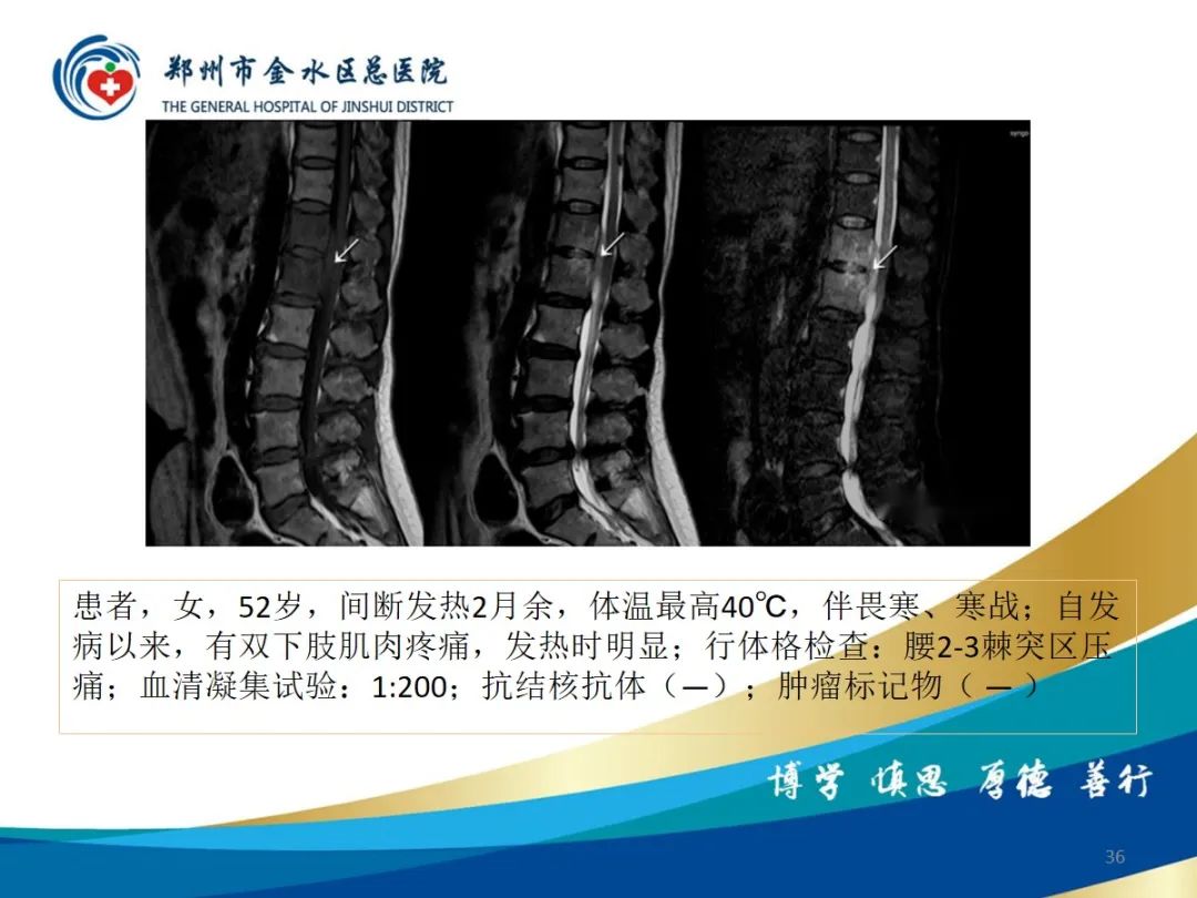 影像PPT - 【PPT】布鲁氏杆菌脊柱炎-36