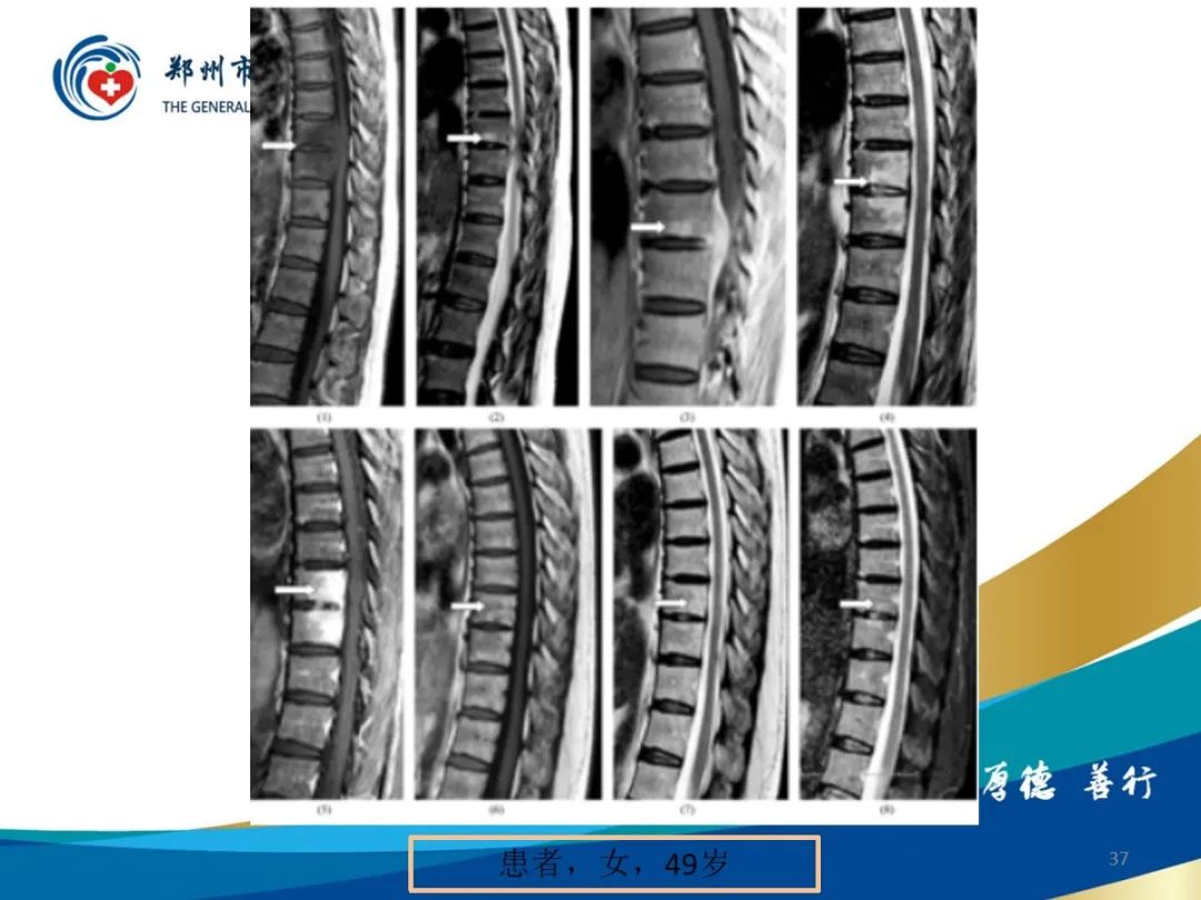 影像PPT - 【PPT】布鲁氏杆菌脊柱炎-37