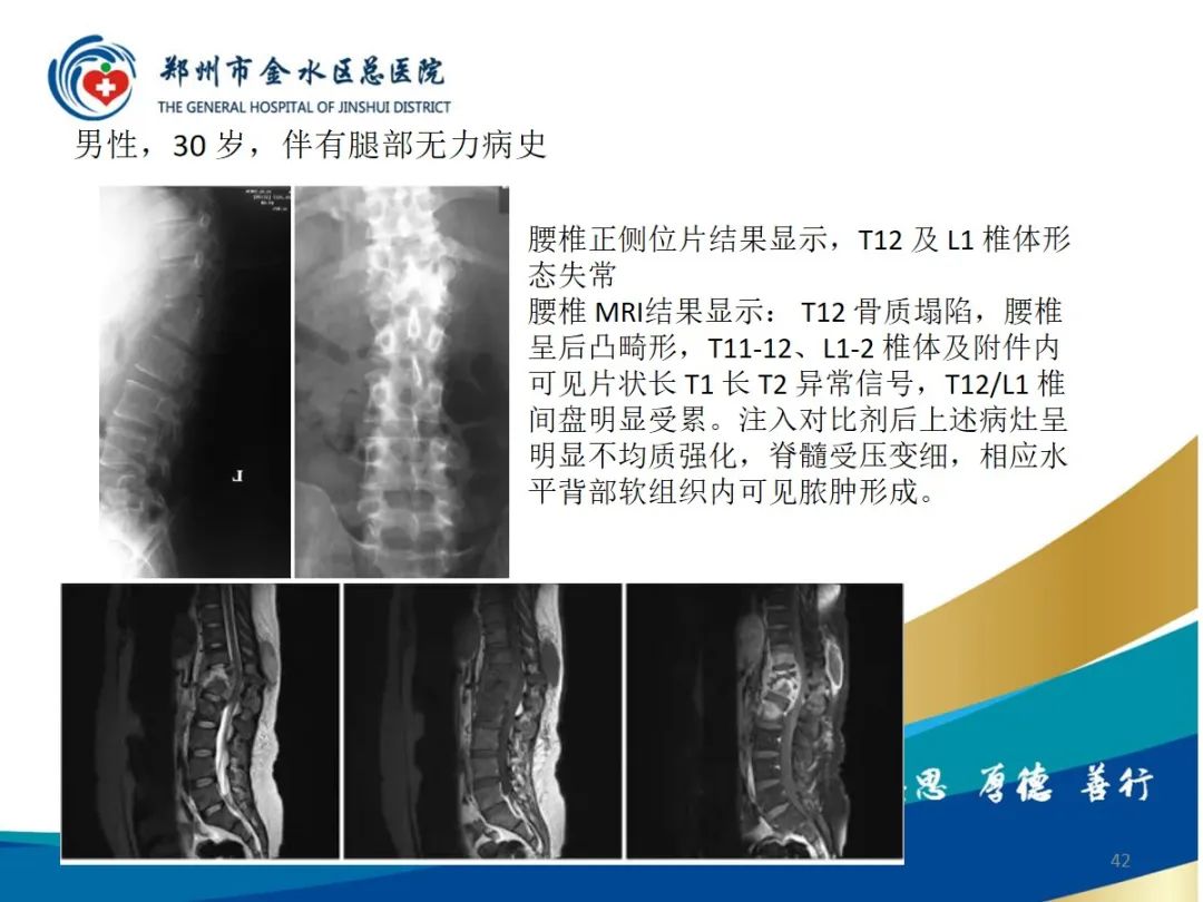 影像PPT - 【PPT】布鲁氏杆菌脊柱炎-42