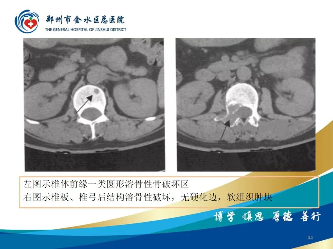 影像PPT - 【PPT】布鲁氏杆菌脊柱炎-44