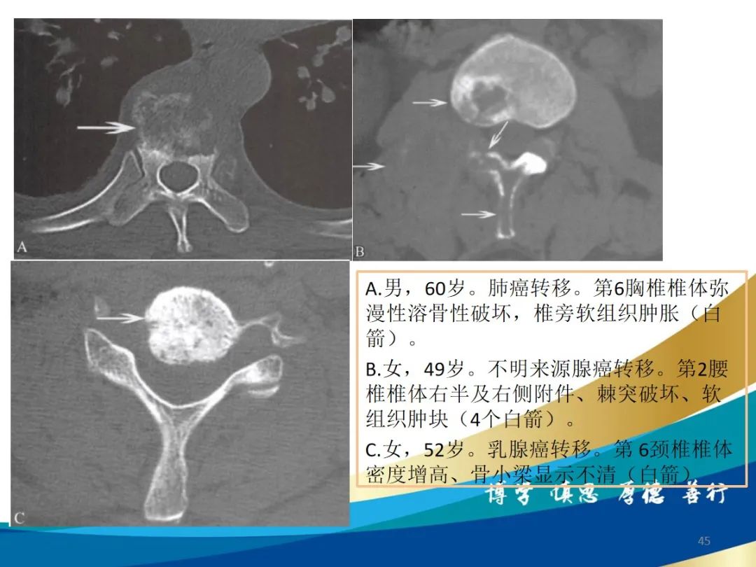 影像PPT - 【PPT】布鲁氏杆菌脊柱炎-45