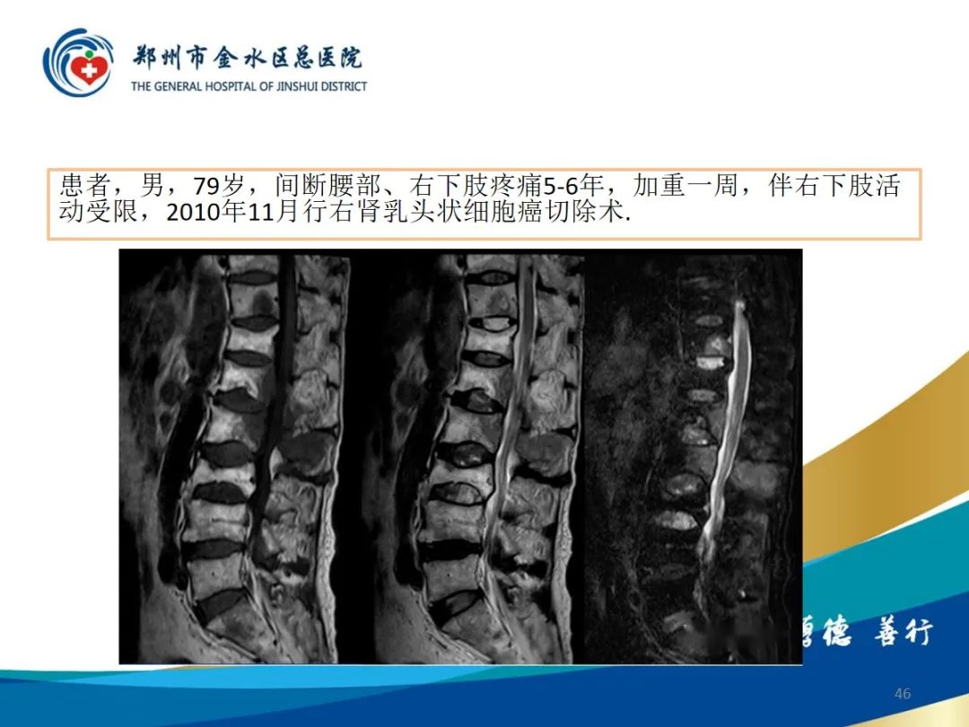 影像PPT - 【PPT】布鲁氏杆菌脊柱炎-46