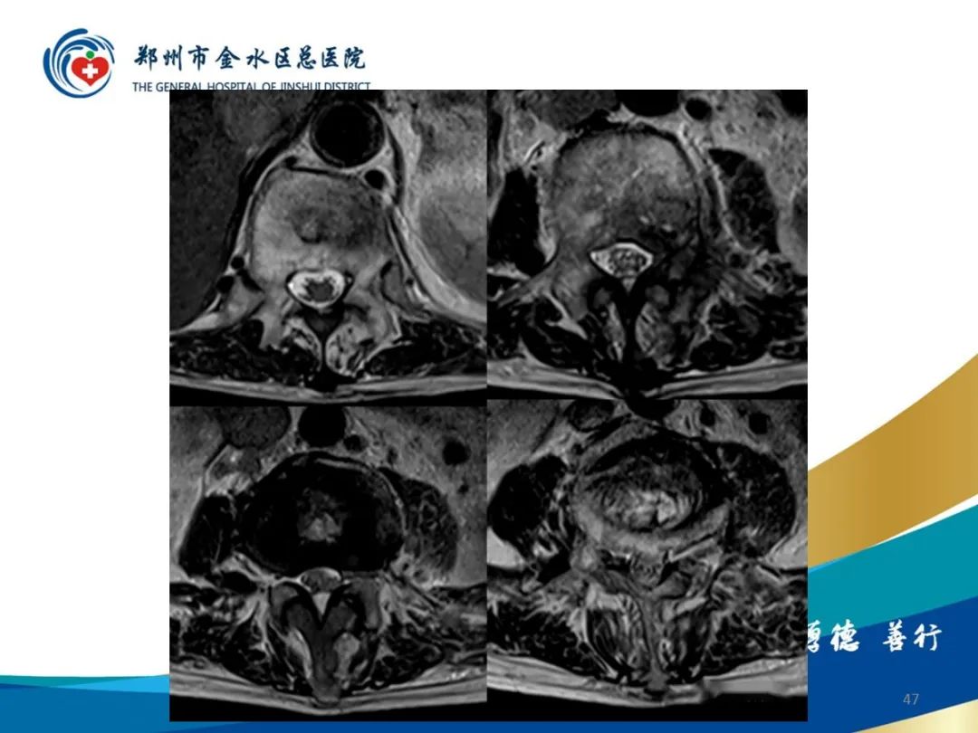 影像PPT - 【PPT】布鲁氏杆菌脊柱炎-47