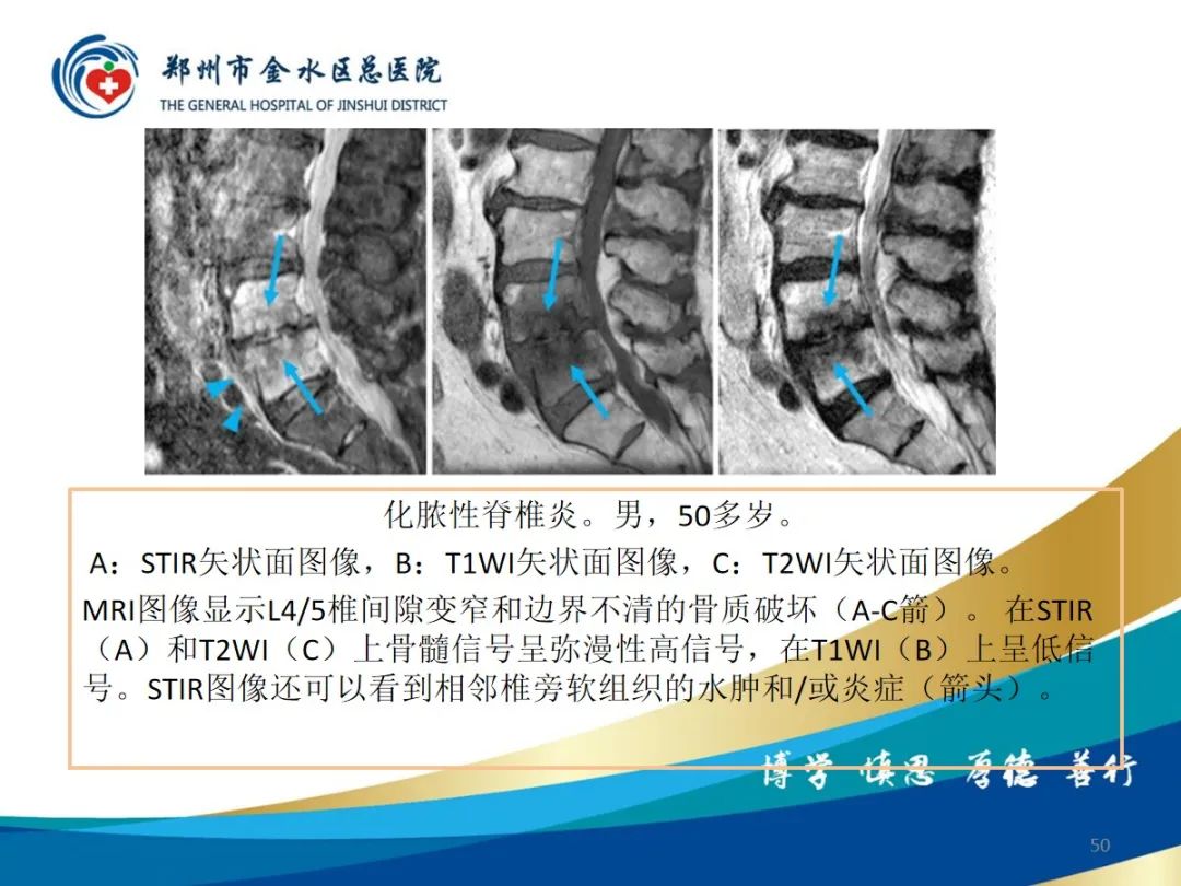 影像PPT - 【PPT】布鲁氏杆菌脊柱炎-50