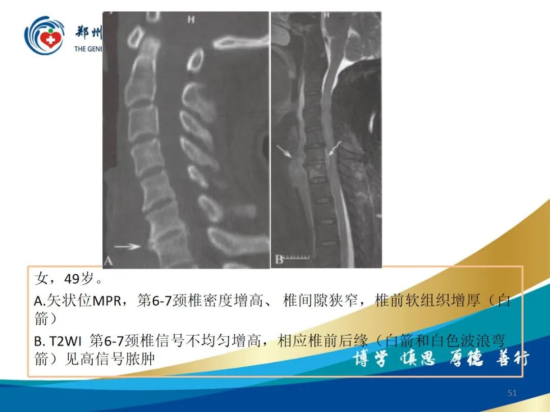 影像PPT - 【PPT】布鲁氏杆菌脊柱炎-51
