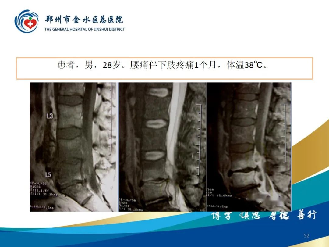 影像PPT - 【PPT】布鲁氏杆菌脊柱炎-52