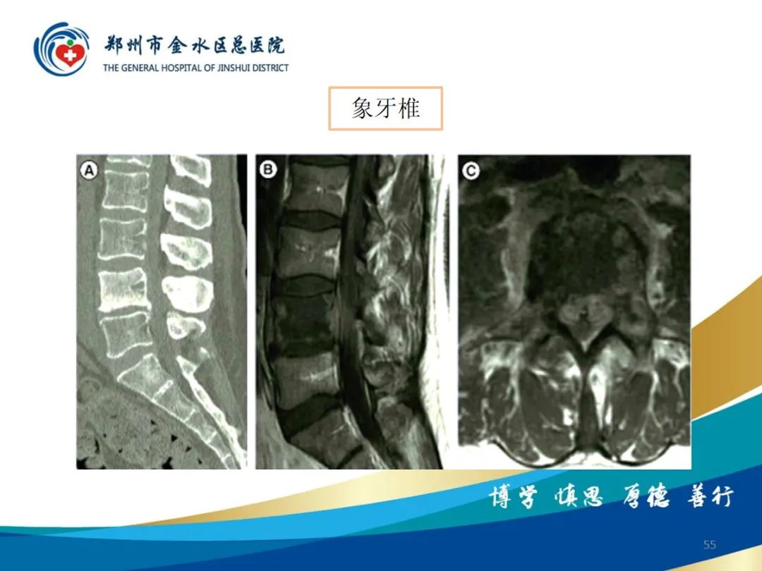 影像PPT - 【PPT】布鲁氏杆菌脊柱炎-55