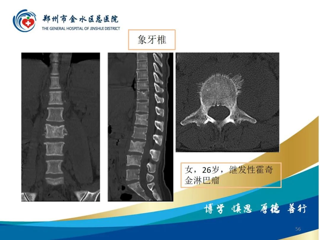 影像PPT - 【PPT】布鲁氏杆菌脊柱炎-56