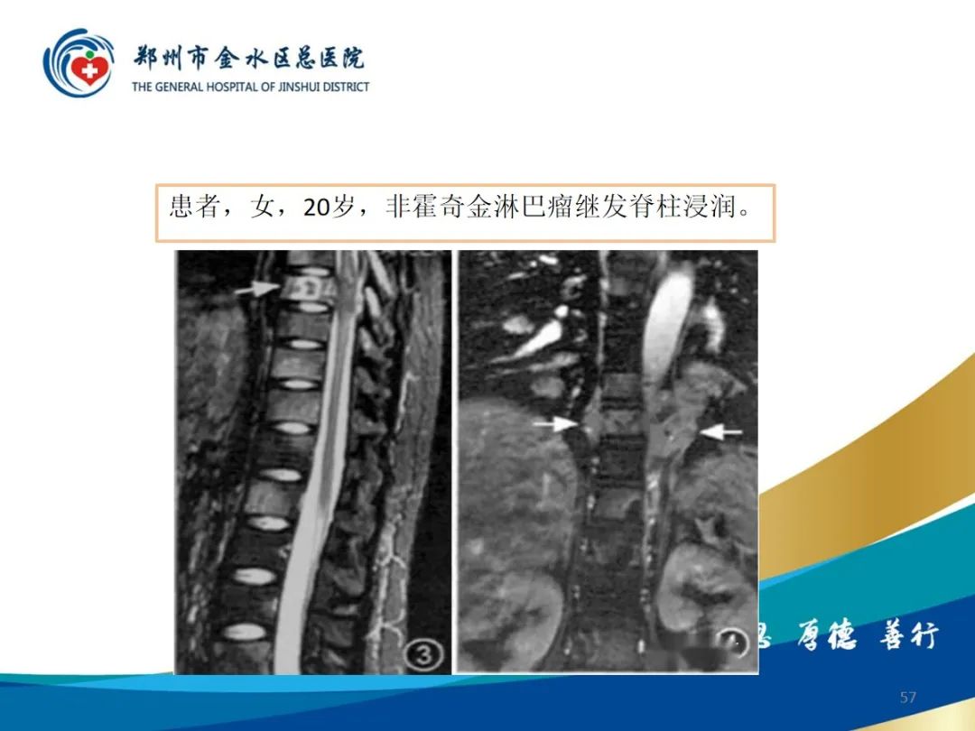 影像PPT - 【PPT】布鲁氏杆菌脊柱炎-57