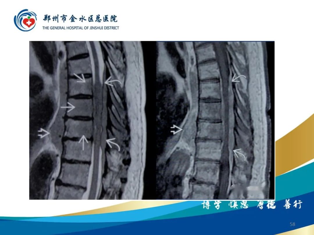 影像PPT - 【PPT】布鲁氏杆菌脊柱炎-58
