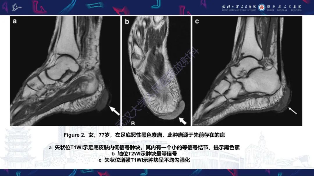 影像PPT - 【PPT】皮肤肿瘤影像诊断-11