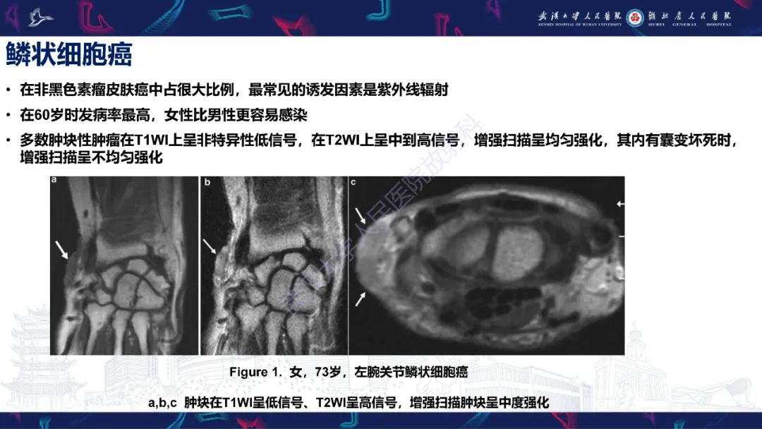影像PPT - 【PPT】皮肤肿瘤影像诊断-9