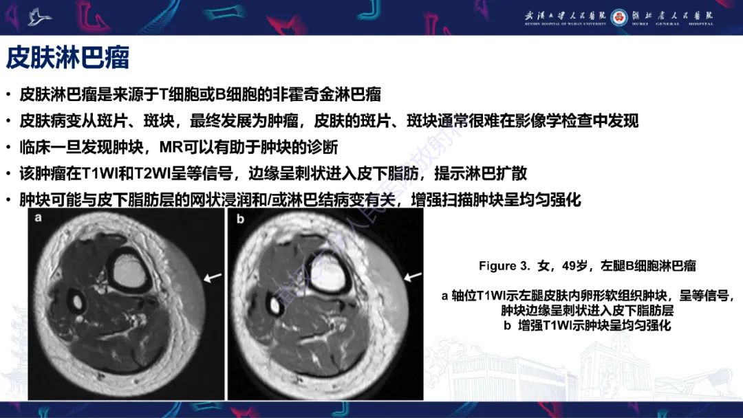 影像PPT - 【PPT】皮肤肿瘤影像诊断-12