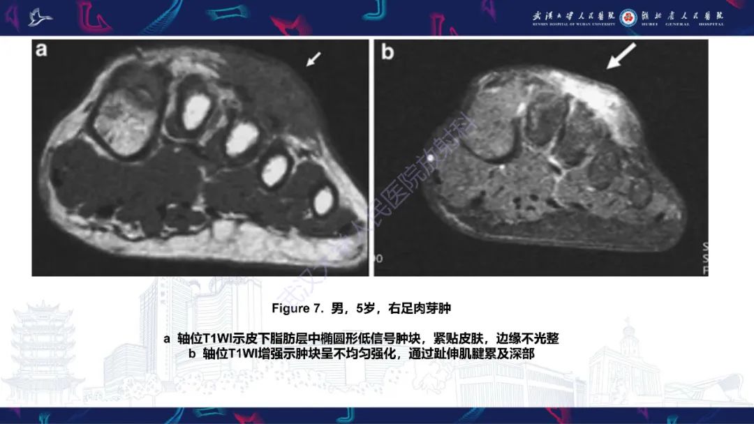 影像PPT - 【PPT】皮肤肿瘤影像诊断-18