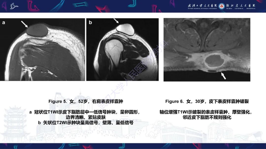 影像PPT - 【PPT】皮肤肿瘤影像诊断-16
