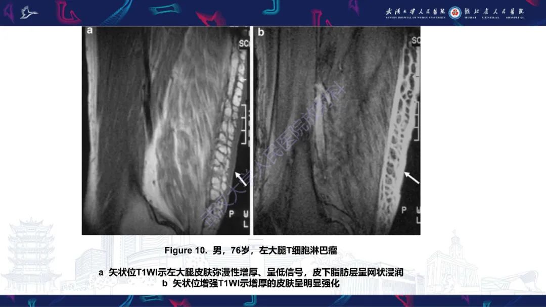 影像PPT - 【PPT】皮肤肿瘤影像诊断-24