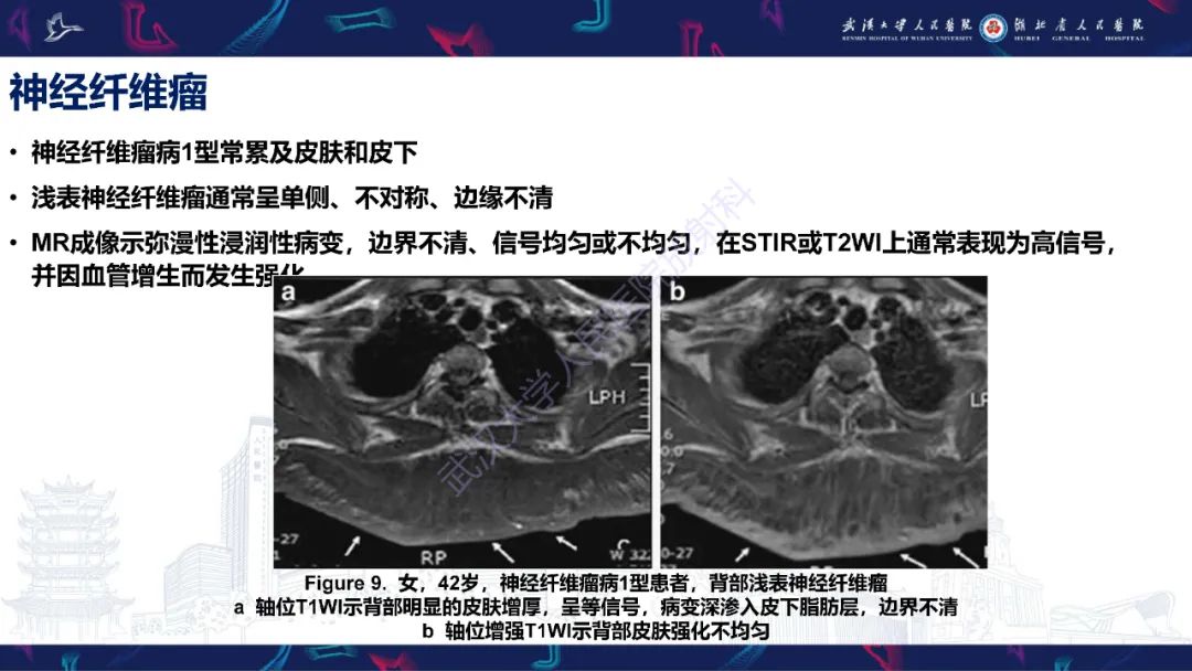 影像PPT - 【PPT】皮肤肿瘤影像诊断-22