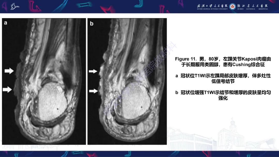 影像PPT - 【PPT】皮肤肿瘤影像诊断-26