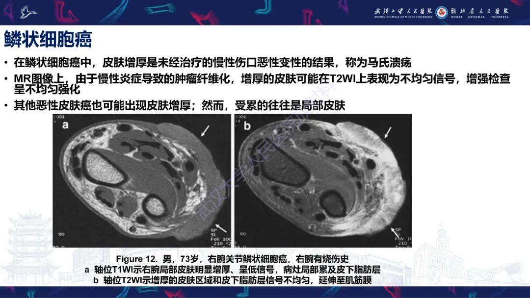 影像PPT - 【PPT】皮肤肿瘤影像诊断-27