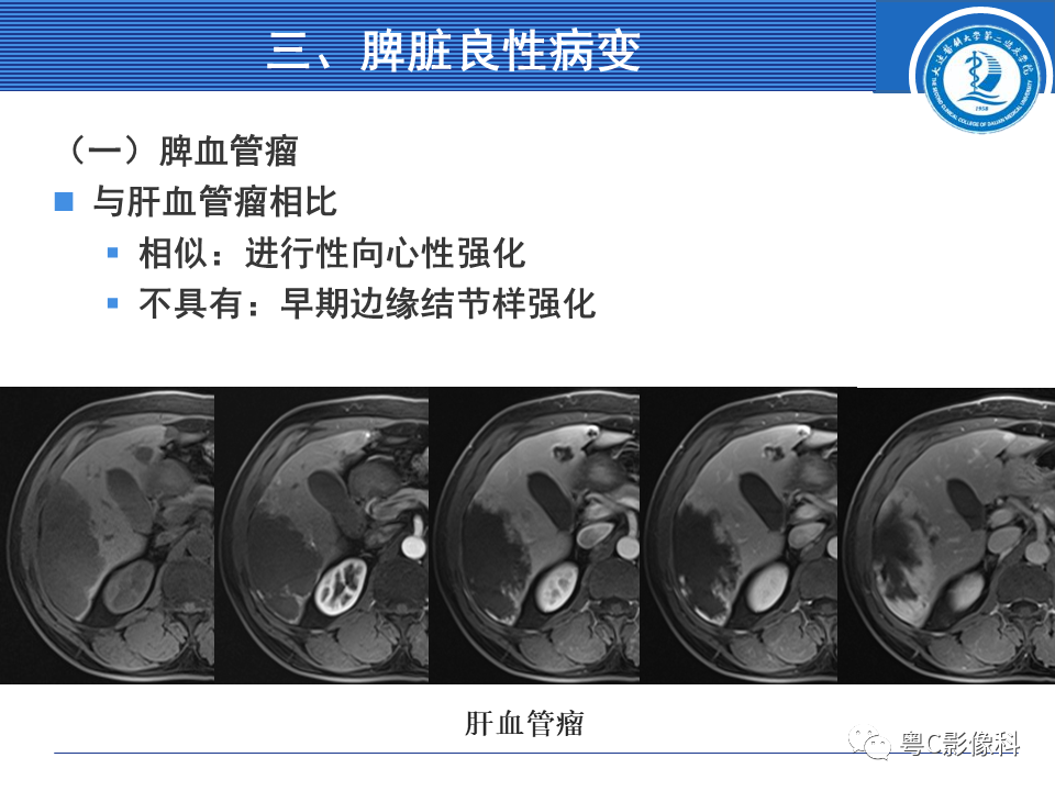 影像PPT - 【PPT】脾脏病变MRI表现-13
