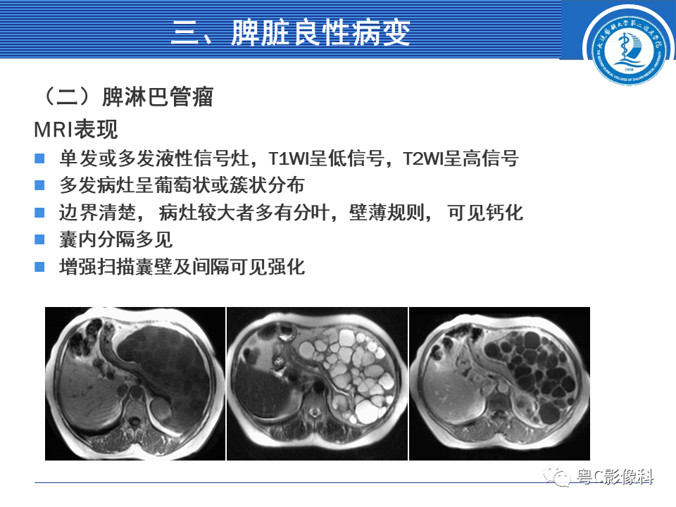 影像PPT - 【PPT】脾脏病变MRI表现-15