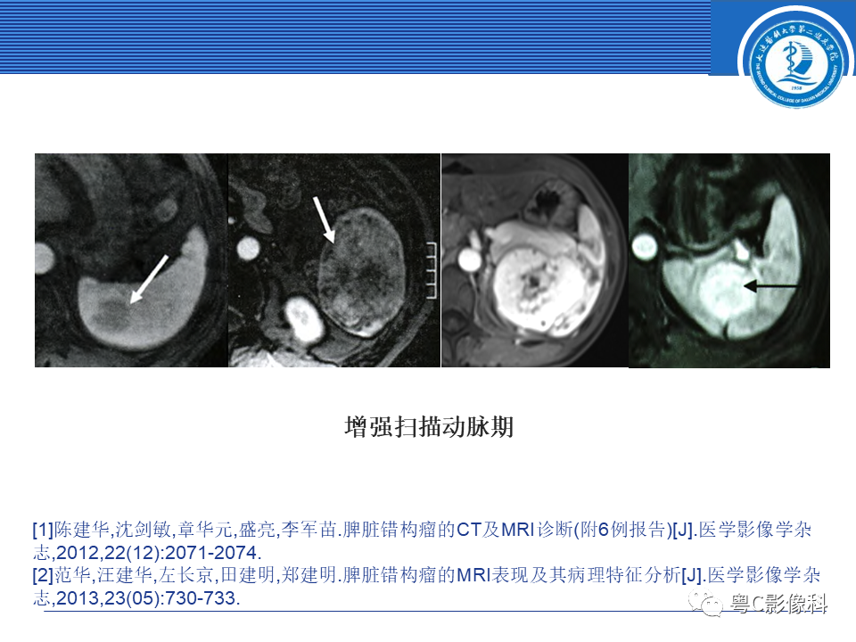 影像PPT - 【PPT】脾脏病变MRI表现-21