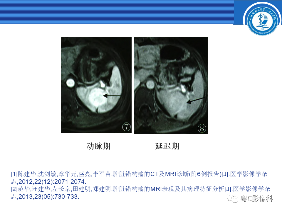 影像PPT - 【PPT】脾脏病变MRI表现-22