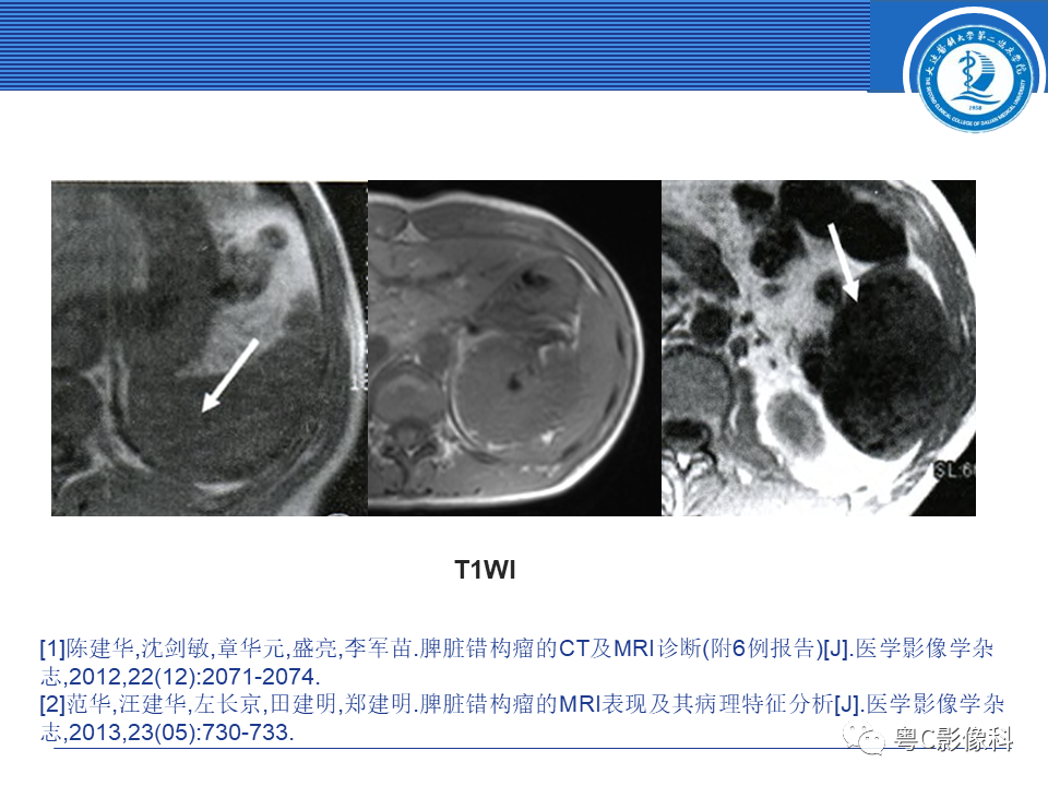 影像PPT - 【PPT】脾脏病变MRI表现-18