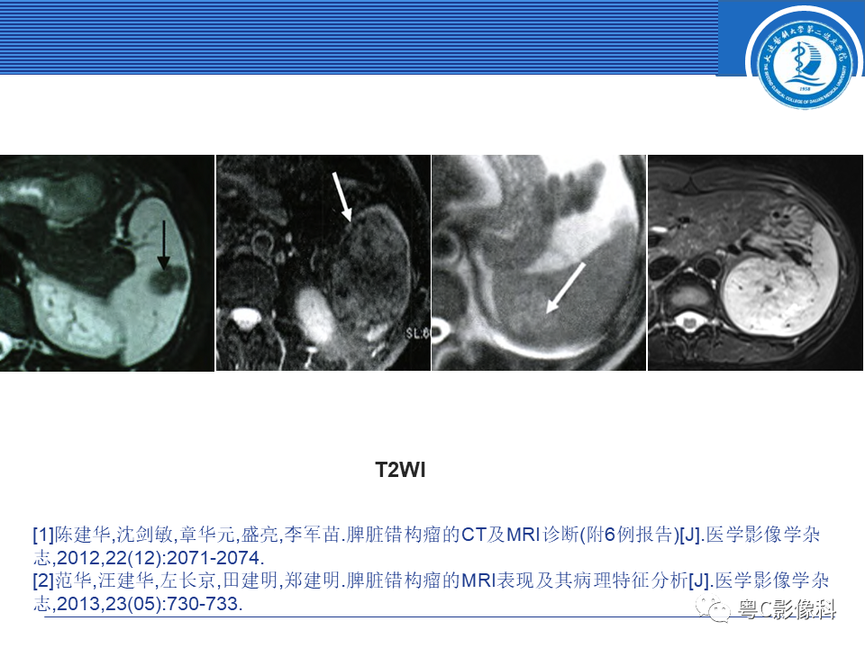 影像PPT - 【PPT】脾脏病变MRI表现-19