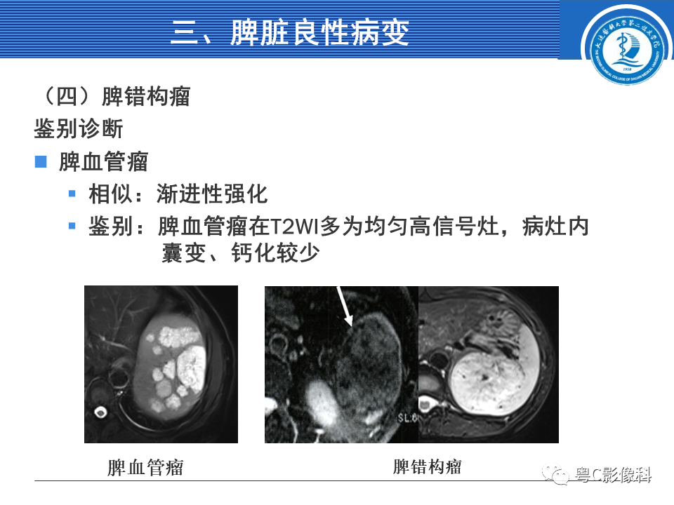 影像PPT - 【PPT】脾脏病变MRI表现-26