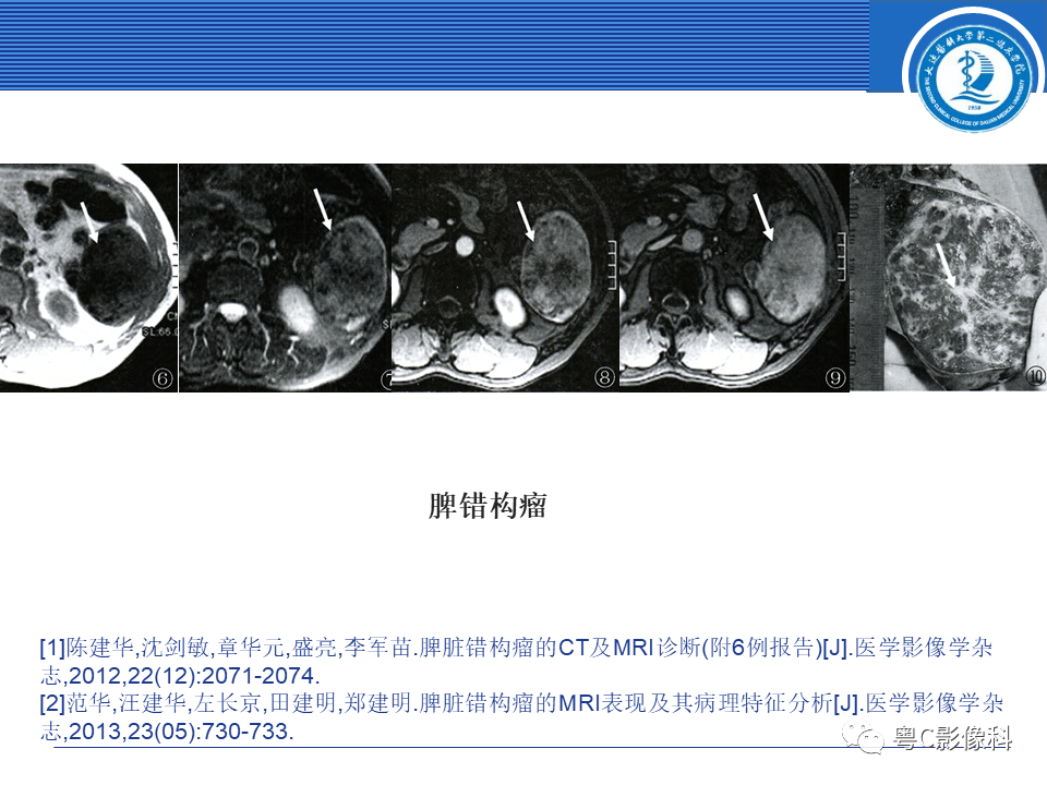 影像PPT - 【PPT】脾脏病变MRI表现-24