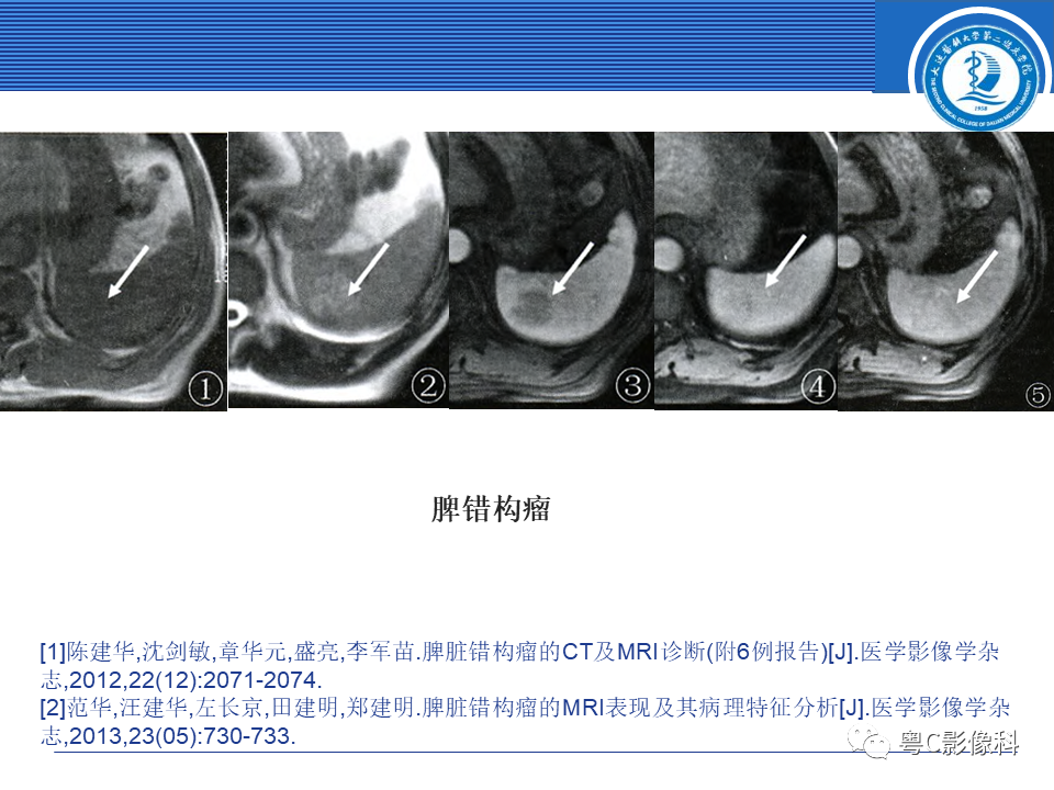 影像PPT - 【PPT】脾脏病变MRI表现-23