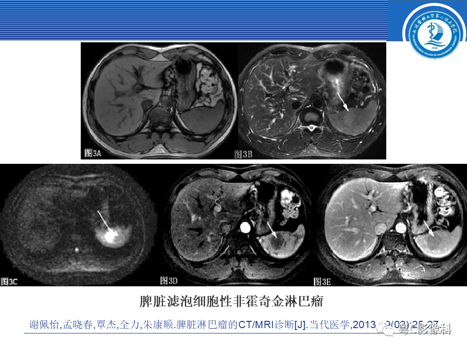 影像PPT - 【PPT】脾脏病变MRI表现-31