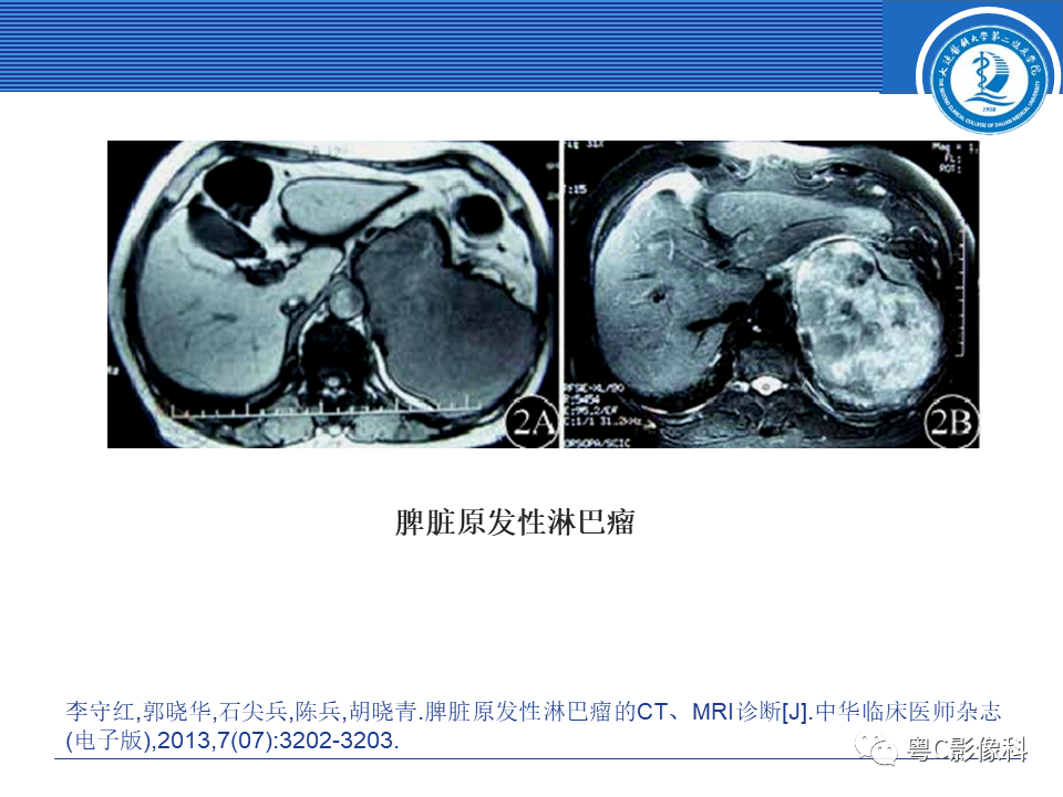 影像PPT - 【PPT】脾脏病变MRI表现-32
